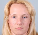 Hair Transplant&nbsp;Hairline